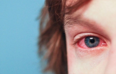 VIÊM LOÉT GIÁC MẠC DO AMIP - NGUYÊN NHÂN, TRIỆU CHỨNG VÀ ĐIỀU TRỊ